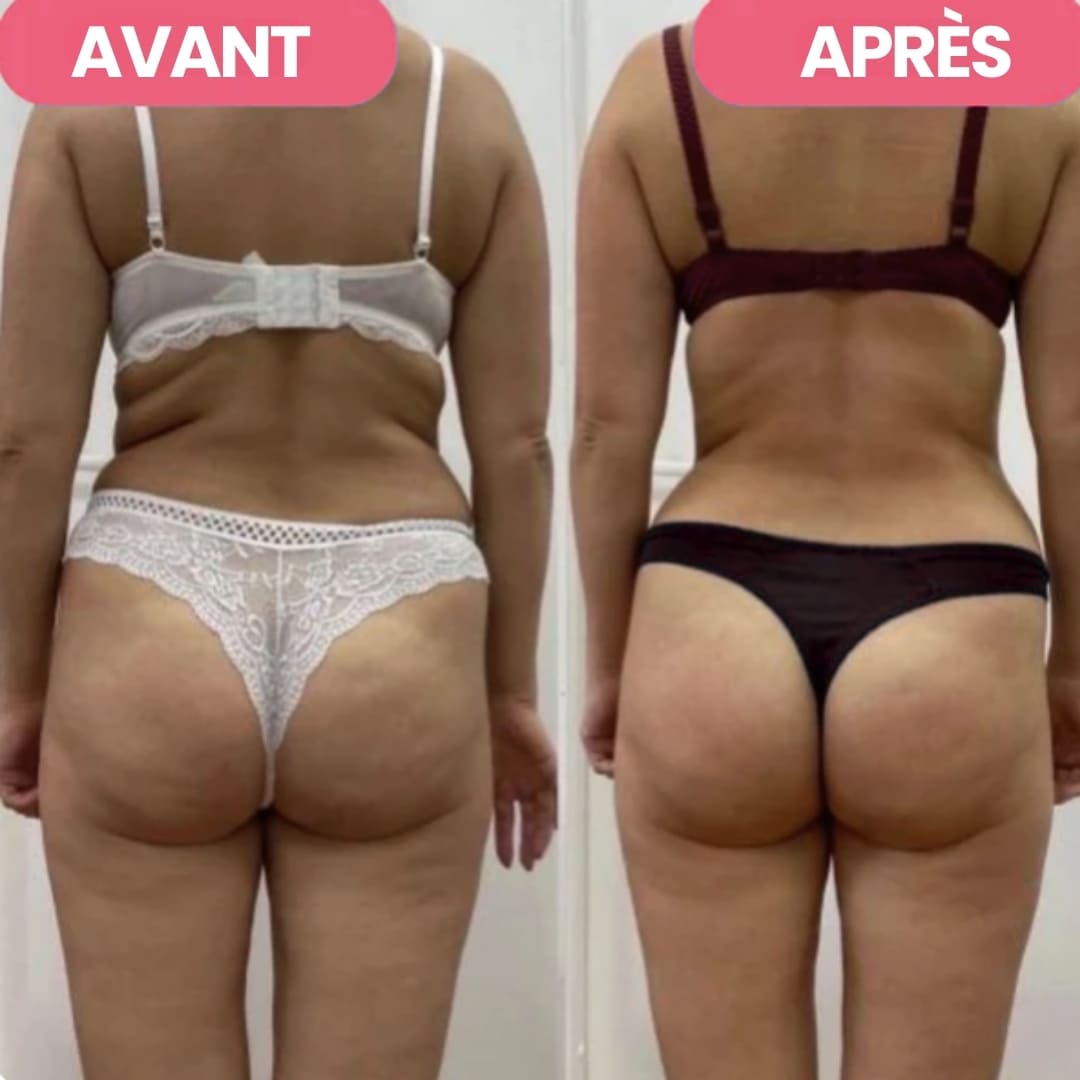 Masseur Anti-Cellulite ResKin™